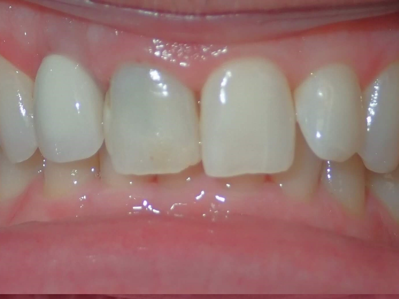 Implant/crowns Before Implant/crowns Before