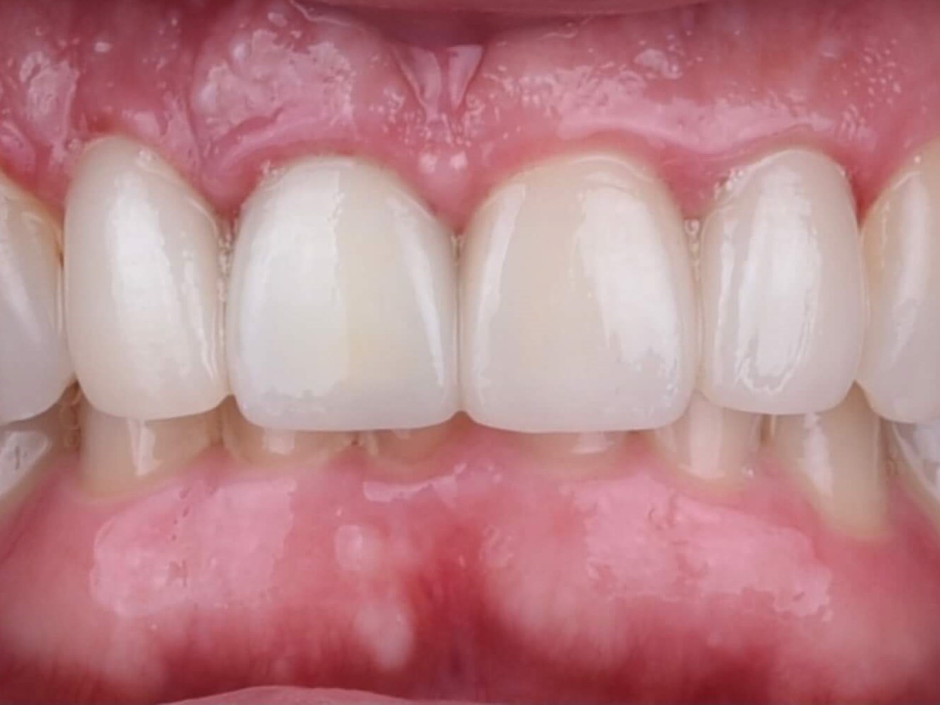 Implant/crowns After Implant/crowns After