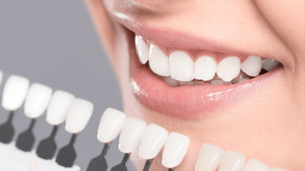Dental Bonding: How to Restore Your Winning Smile